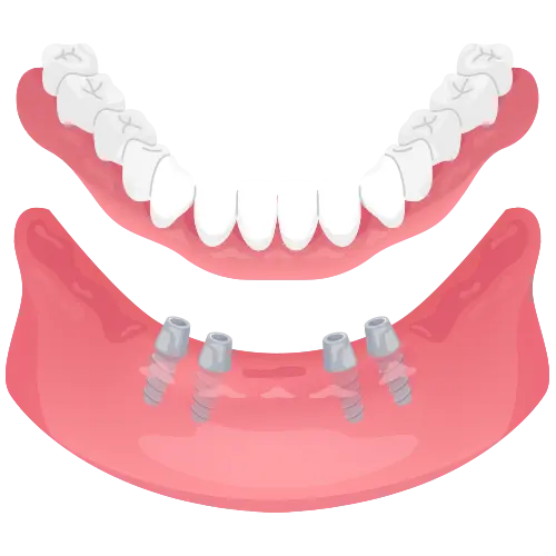 full-dentures-glojas