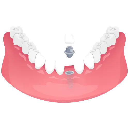 implants dentures glojas