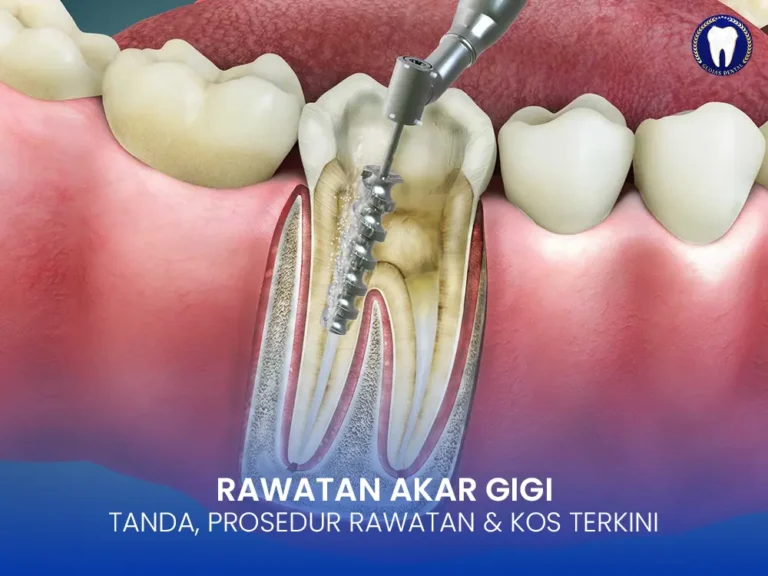 rawatan-akar-gigi-root-canal-treatment-malaysia