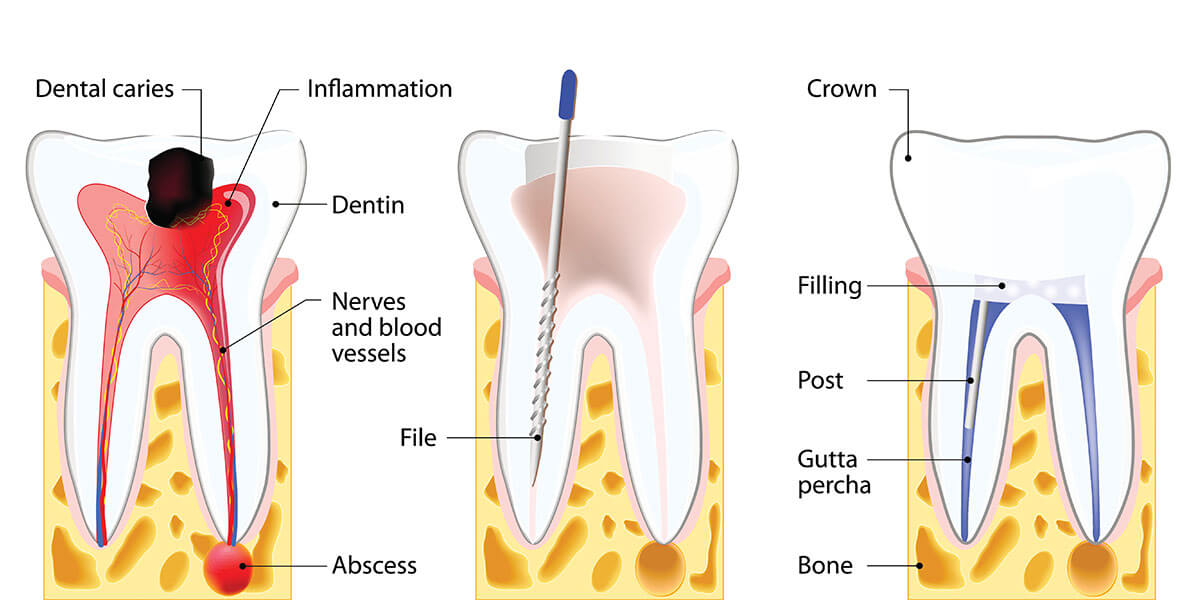 Root Canal Treatment: Safe, Effective & Pain-Free Dental Care