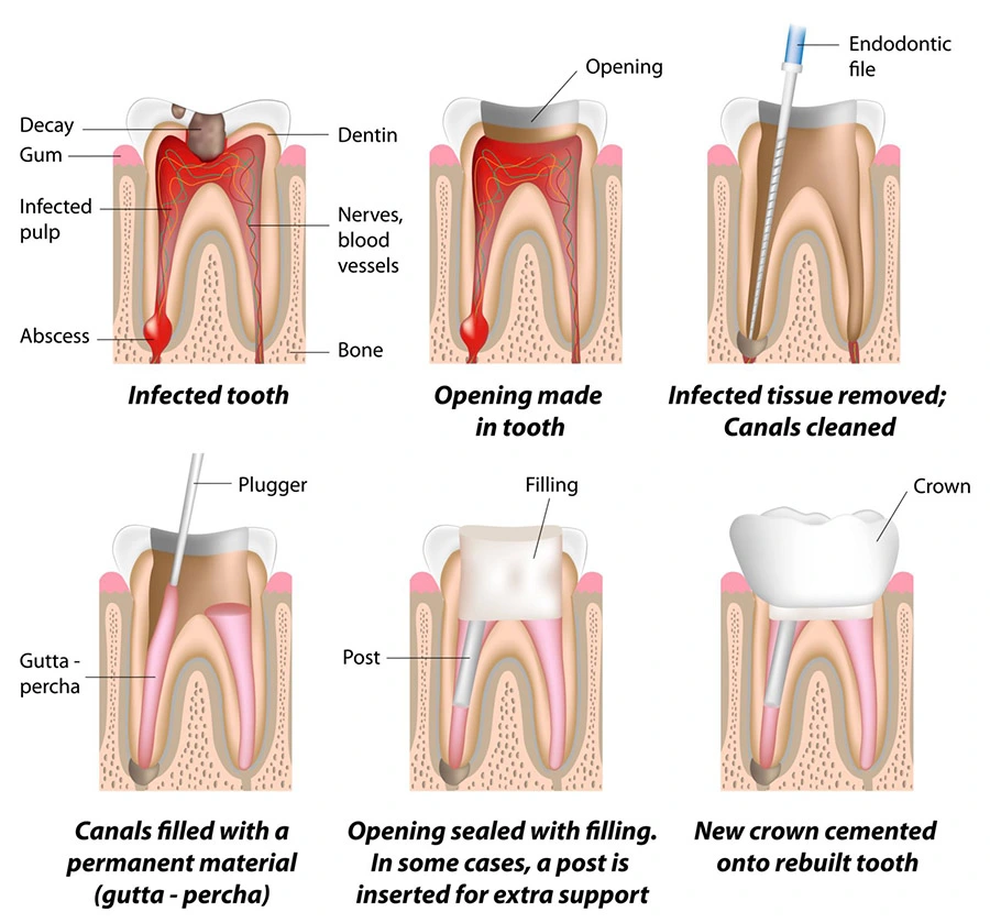 root-canal-treatment-rawatan-akar-gigi-kuala-lumpur-malaysia