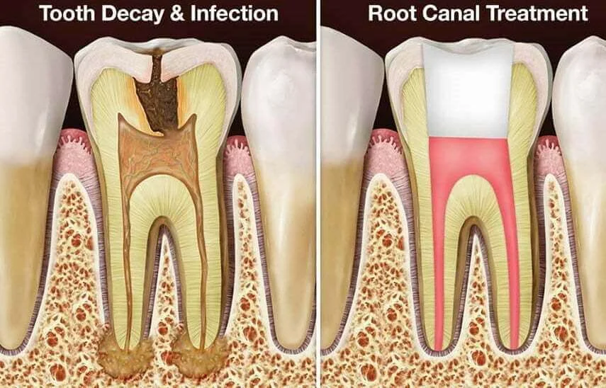 root-canal-treatment-rawatan-akar-gigi-kuala-lumpur-malaysia