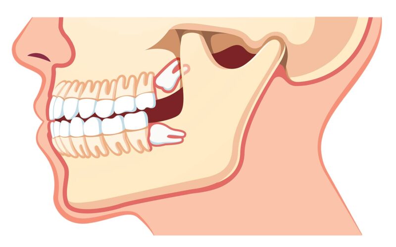 gigi-bongsu-wisdom-tooth