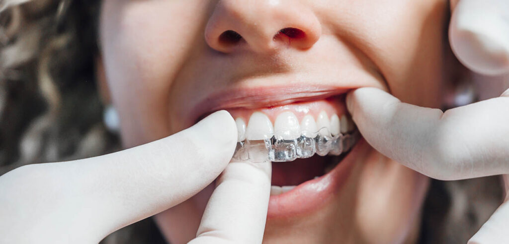 clear-aligners-malaysia-orthodontics-kuala-lumpur