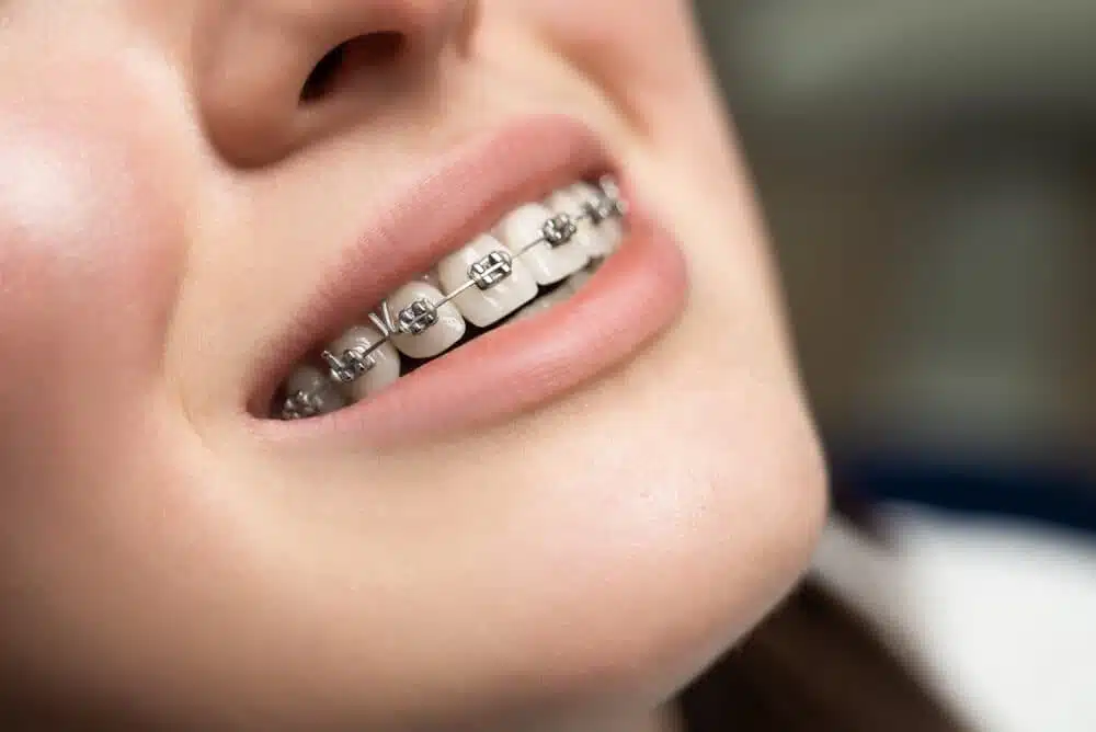 harga-braces-kuala-lumpur