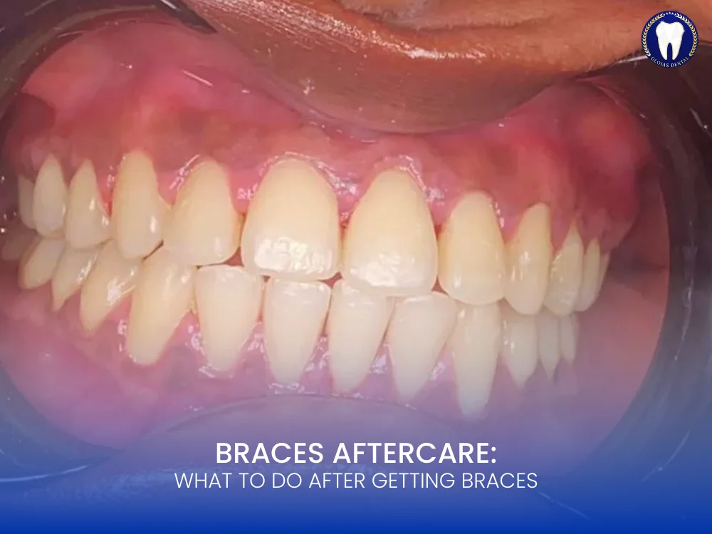 braces-aftercare