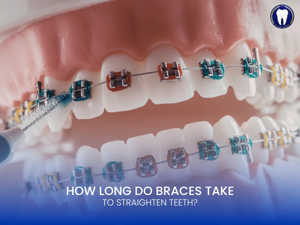how-long-do-braces-take